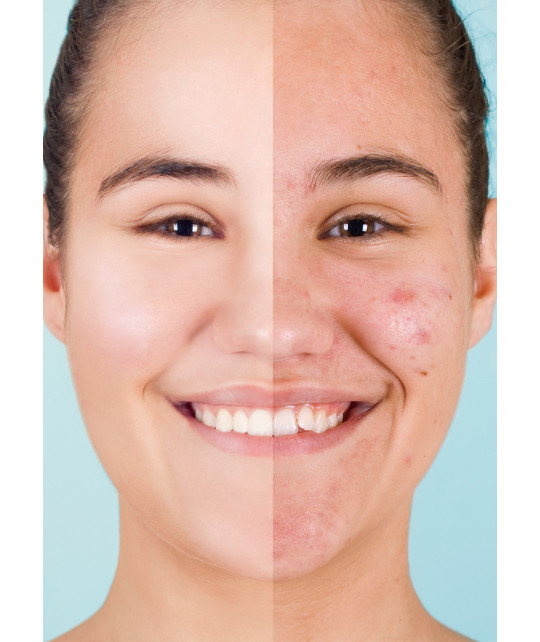 Affrontare l'acne con delicatezza: consigli naturali per giovani pelli in crescita